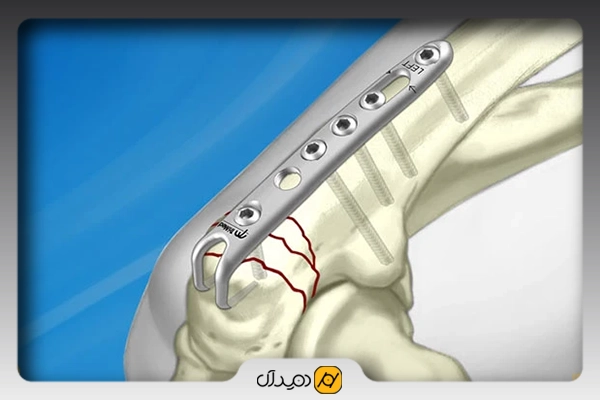 پلاتین چیست + کاربرد و انواع